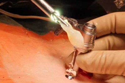 Arbeitszugang und der große Bandscheibenvorfall an einer Greifzange