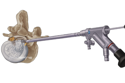 Wirbelkörper mit Bandscheibenvorfall und ENdoskop