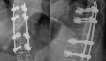 Wirbelkörperbrüche Rücken Radiologie