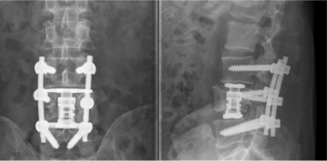 Wirbelkörperbrüche Radiologie