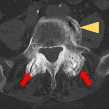  CT-Horizontalschnitt durch einen Wirbelkörper (Pfeile rot: kleine Wirbelkörpergelenke mit Verlust der Beweglichkeit und Aufbrauchen des Gelenkspalts durch Arthrose; Pfeil gelb: benachbarte wirbelkörperüberspannende Knochenbrücken)